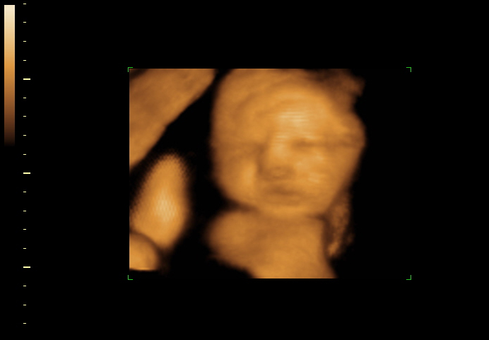 3D ultrasound image at 33 weeks